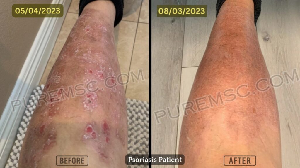 Psoriasis Before And After Patient